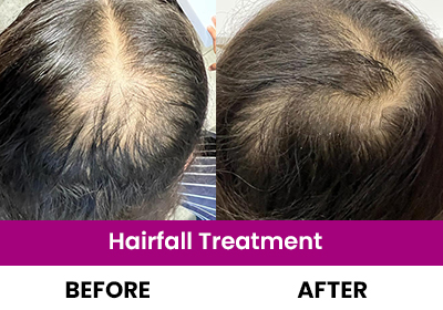Hairfall treatment Near Kalavad Road