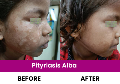 Pityriasis Alba Rajkot