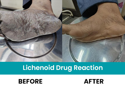 Lichenoid Drug Reaction solution Near me