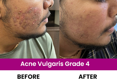 Professional of Acne Vulgaris