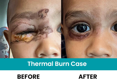 Specialist of Thermal Burn Case