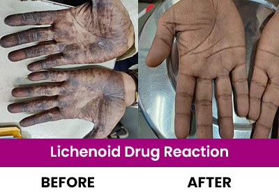 LIchenoid Drug Reaction Result