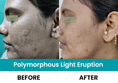 Polymorphous light Eruption Dermatologist